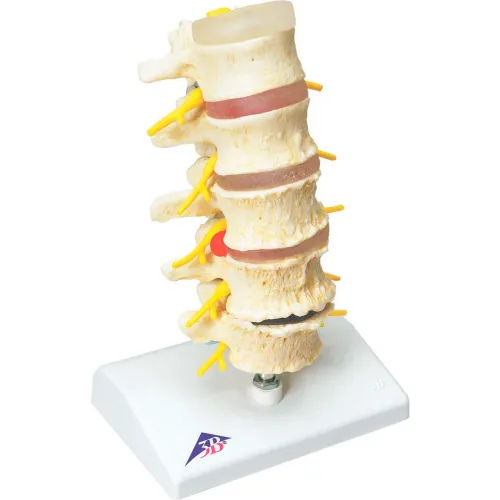3B® Anatomical Model - Vertebrae Degeneration, Stages of Prolapsed Disc